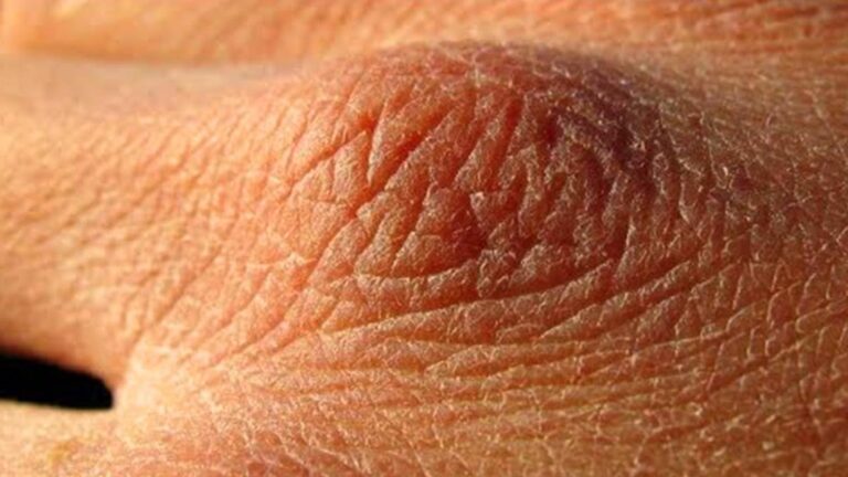 Questo metodo semplice rivela come riconoscere la disidratazione…