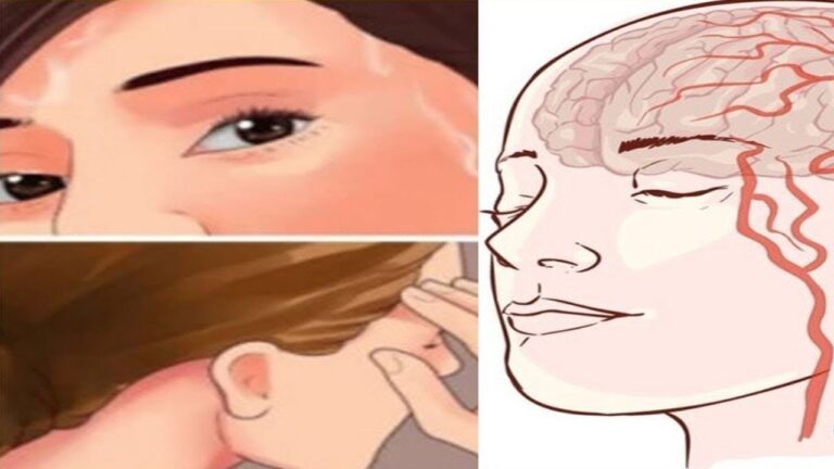 7 segnali che indicano un imminente rischio di ictus da non ignorare
